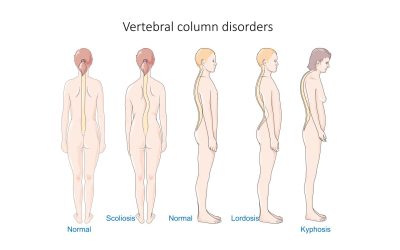 Mal de dos : causes, symptômes, traitements et solutions durables pour soulager la douleur